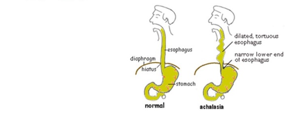 Achalasia Symptoms, Causes and Natural Treatment