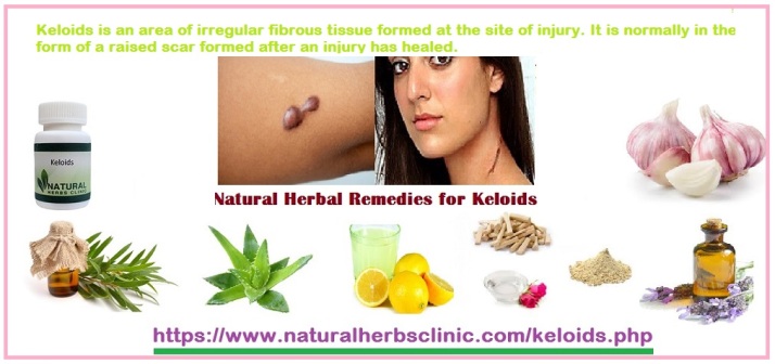 Keloids Herbal Treatment